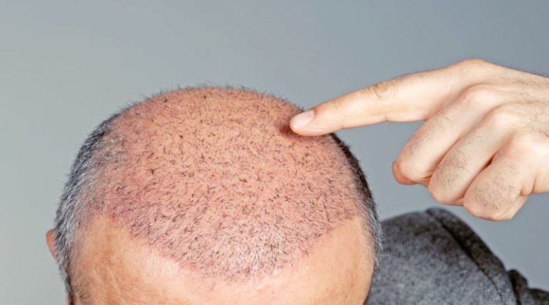 Is a Hair Transplant Permanent? 